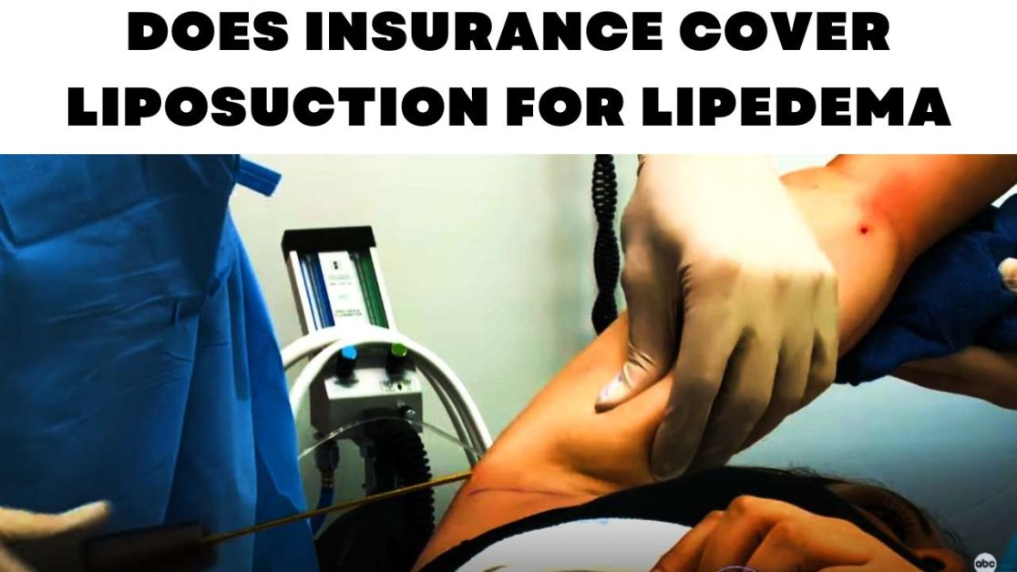 Does insurance cover liposuction for lipedema